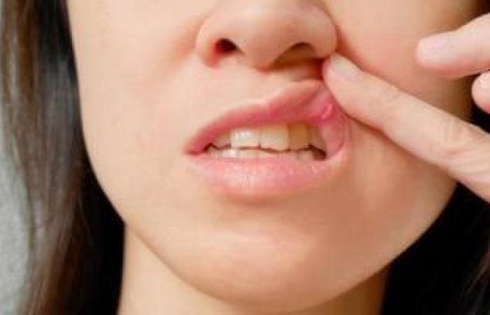 صحة وطب : كيف تقى نفسك من التعرض لقرح الفم ؟