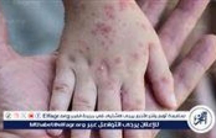 أخبار العالم : وزارة الصحة والسكان تنشط الإجراءات الوقائية لمواجهة مرض "M Pox" جدري القرود