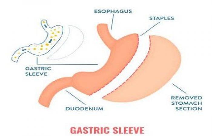 ما هي أضرار عملية تحويل مسار المعدة على المدى البعيد؟ دكتور أسامة خليل