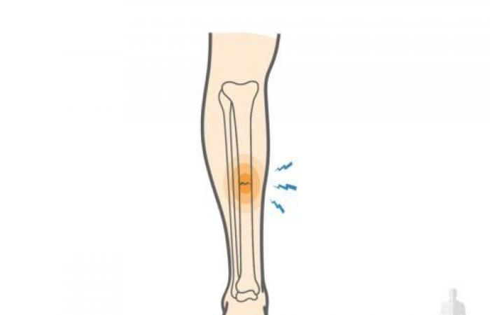 كسور الإجهاد| تعرف على الأسباب والأعراض.. وهؤلاء الأكثر عرضة للإصابة