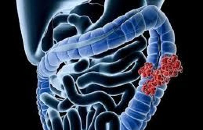 دراسة: مرضى الزهايمر أقل عرضة للإصابة بسرطان القولون والمستقيم