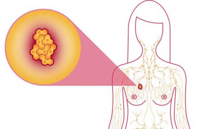 أعراض غير شائعة لسرطان الثدي يجب على كل امرأة معرفتها| تفاصيل